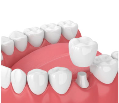 Image of dental crown in Chelsea MA