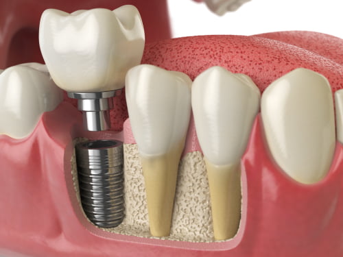 Dental implant example for teeth replacement in Chelsea MA.