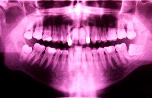 X-ray shows patient needs teeth extraction to improve dental health in Chelsea MA