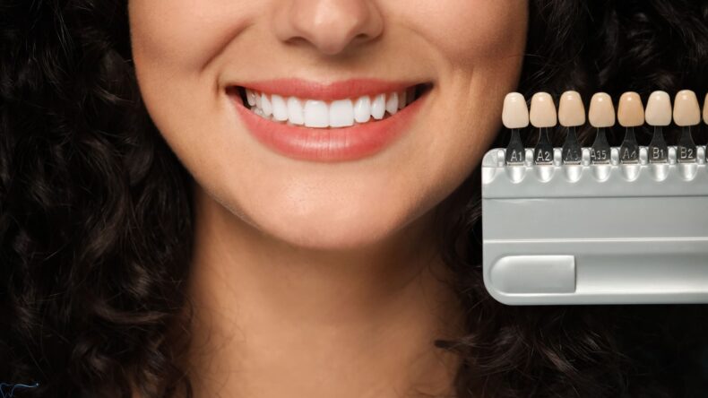Top Benefits of Porcelain Veneers in Chelsea: Smile Transformation